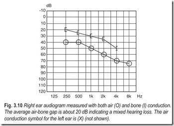 Fig. 3.10 Right ear audiogram measured with both air (O) and bone (I) conduction.  The average air-b